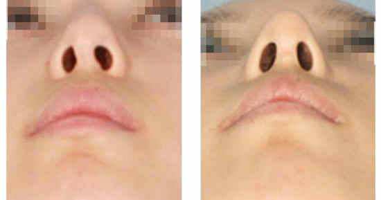 鼻小柱畸形有办法改善吗？