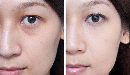 激光祛眼周皱纹对皮肤有伤害吗