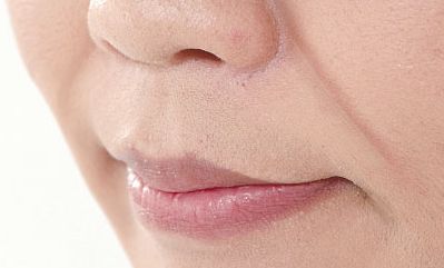 怎么丰鼻唇沟效果最好呢？