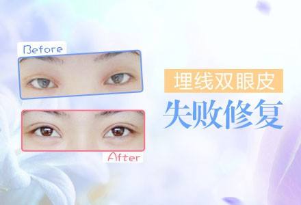 2019年北京双眼皮修复专家有哪些？王世勇和王振军哪个更好？