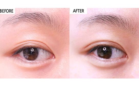 北京艾玛李方奇双眼皮修复技术怎么样？有双眼皮修复案例吗？