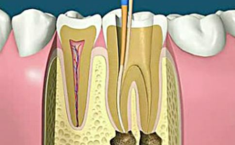 根管治疗就是抽牙神经吗？根管治疗和牙髓治疗是一回事吗？