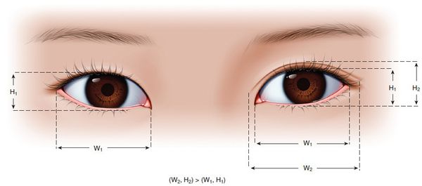 眼整形解密（三）：决定双眼皮的关键密码有哪些? 各有什么优缺点?