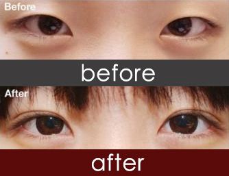 赵红艺和李斌斌哪个医生做双眼皮修复比较好？