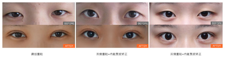 北京八大处宋涛做双眼皮技术怎么样？宋涛双眼皮预约热线