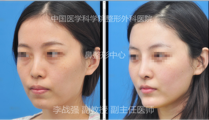 北京八大处整形外科最好的隆鼻&鼻修复专家：李战强（简介、案例、预约）