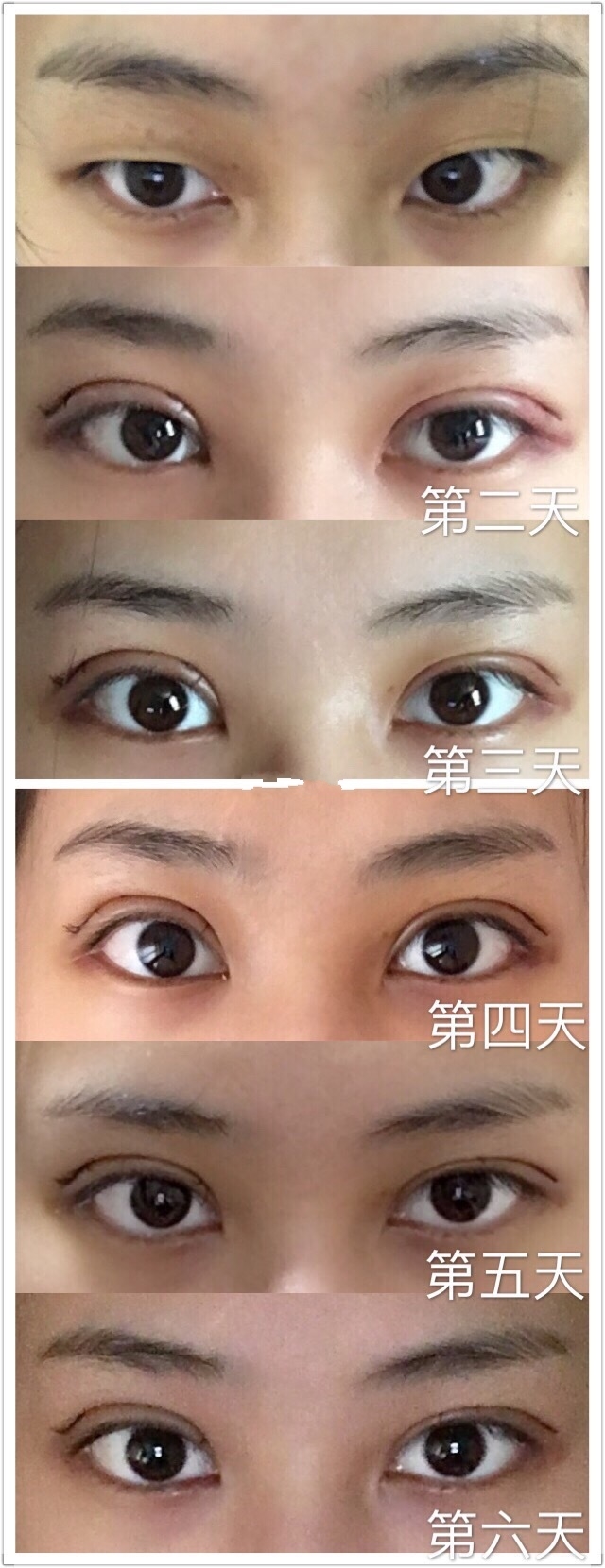 上海九院朱慧敏割双眼皮技术好不好？上海九院最好的双眼皮专家：朱慧敏预约