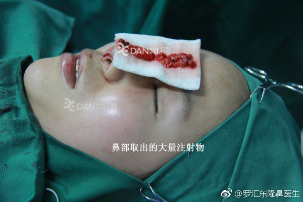 北京哪位医生擅长做鼻部注射物取出手术？鼻部微晶瓷,骨粉,奥美定取出专家