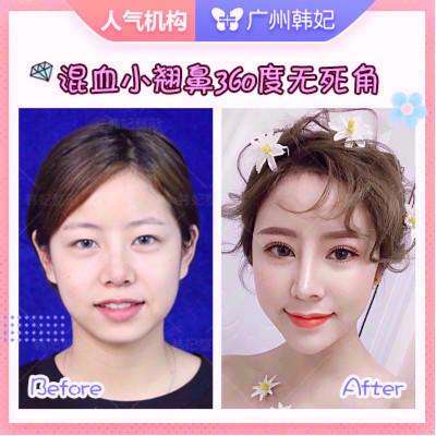 广州罗延平和欧阳春哪个隆鼻技术好？欧阳春和罗延平隆鼻&鼻修复案例预约