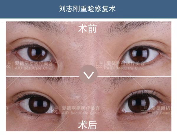 大连双眼皮修复专家刘志刚技术好不好？大连刘志刚双眼皮修复案例预约