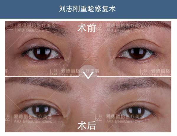 大连双眼皮修复专家刘志刚技术好不好？大连刘志刚双眼皮修复案例预约