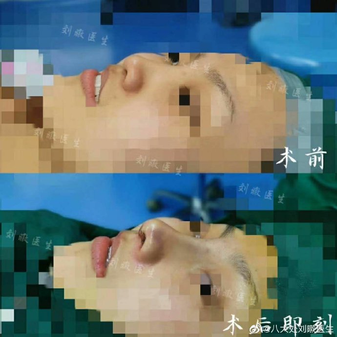 北京八大处隆鼻&鼻修复&鼻部整形最好的专家：刘暾（简介案例预约）怎么样？