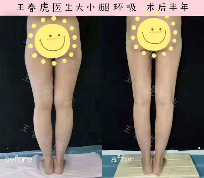 北京八大处大腿抽脂&腿部塑形最好的专家：王春虎（案例效果预约）怎么样？