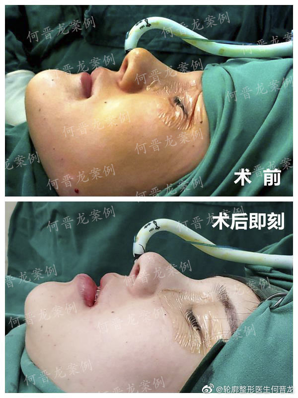 上海时光磨骨专家：何晋龙（简介案例预约）下颌角效果怎么样？