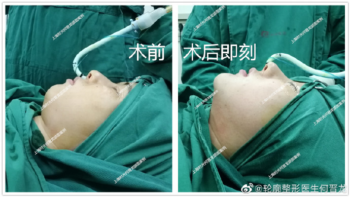 上海时光磨骨专家：何晋龙（简介案例预约）下颌角效果怎么样？