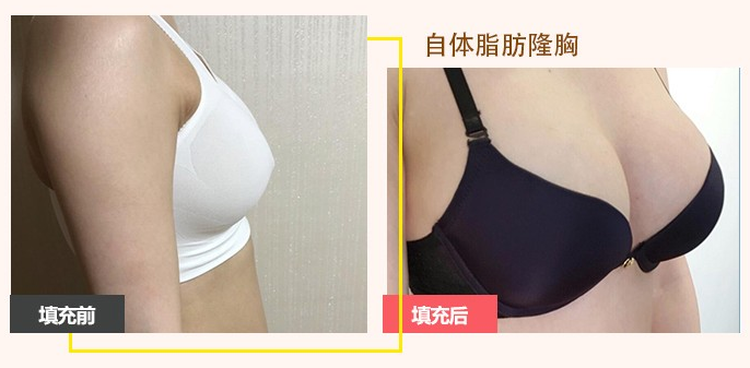 中国最好的脂肪填充专家推荐：孙瑞霞（简介案例预约效果）怎么样？