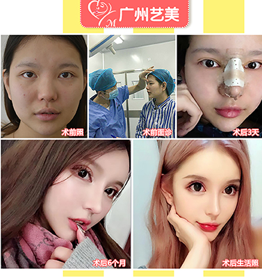 广州最好的隆鼻&鼻修复专家推荐：李闯（简介预约案例效果）怎么样？