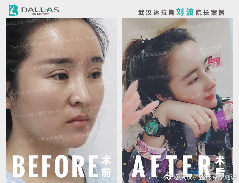 武汉最厉害的隆鼻&鼻修复&鼻部整形专家：刘波（案例预约）怎么样？