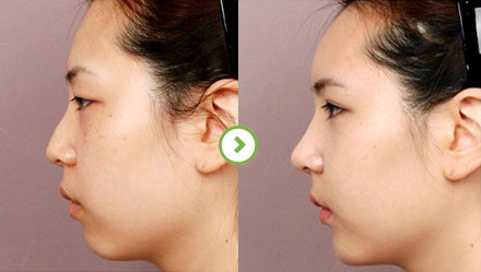 中国最厉害的鼻子&鼻修复专家（亚洲鼻王）：郑东学（案例效果预约）真的好吗
