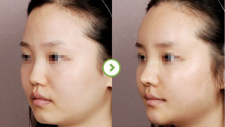 中国最厉害的鼻子&鼻修复专家（亚洲鼻王）：郑东学（案例效果预约）真的好吗