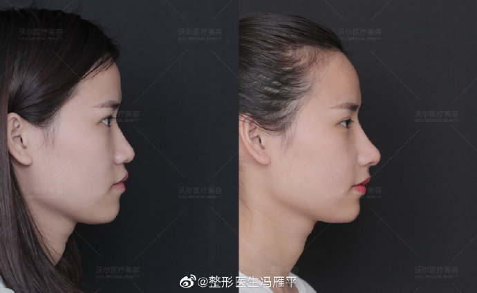 北京做鼻尖垫鼻尖最好的专家推荐：沃尔冯雁平（预约价格效果）怎么样