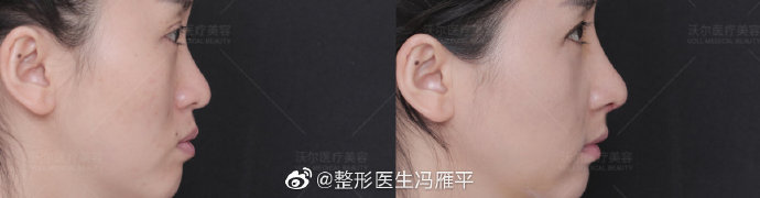 北京做鼻尖垫鼻尖最好的专家推荐：沃尔冯雁平（预约价格效果）怎么样