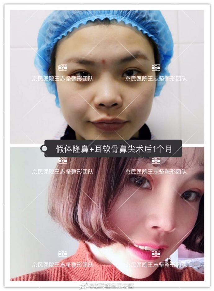 北京做鼻子&鼻修复专家推荐：京民王志坚（案例价格预约效果）怎么样？