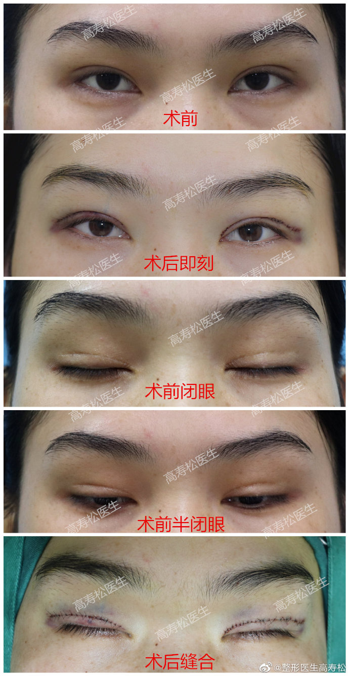 杭州修复双眼皮知名专家推荐：高寿松（案例预约效果）双眼皮修复怎么样？