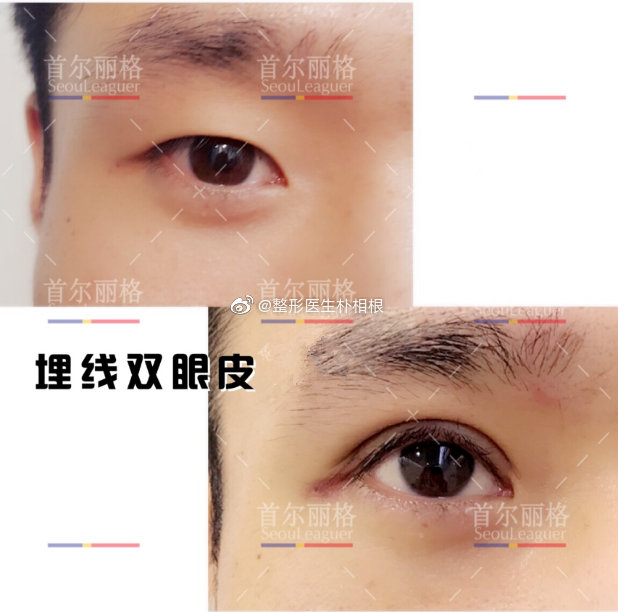 上海做双眼皮知名专家有哪些？上海朴相根做双眼皮效果好吗？