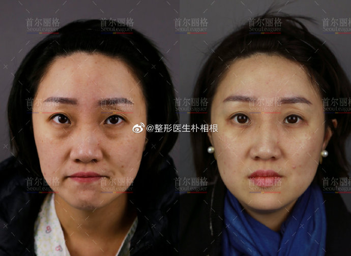 上海做双眼皮知名专家有哪些？上海朴相根做双眼皮效果好吗？