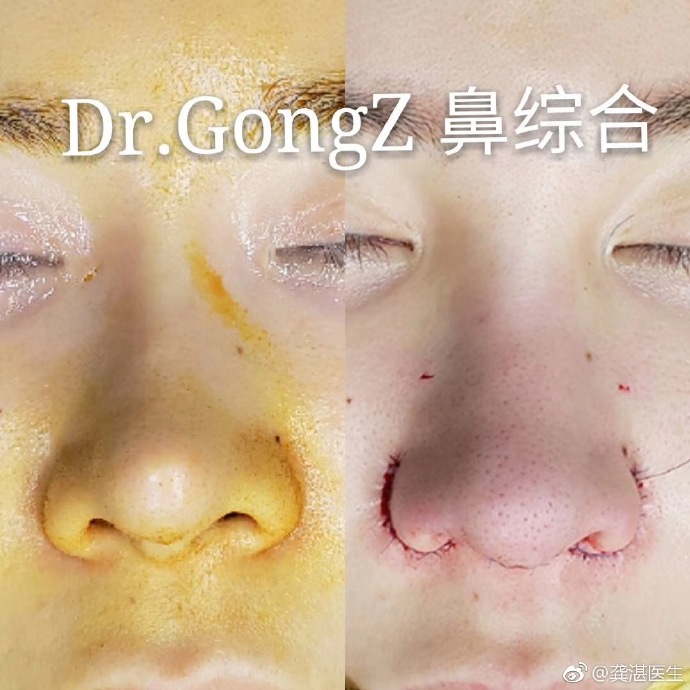 广州做鼻子&网红鼻&鼻修复知名专家推荐：龚湛（案例效果预约）怎么样？