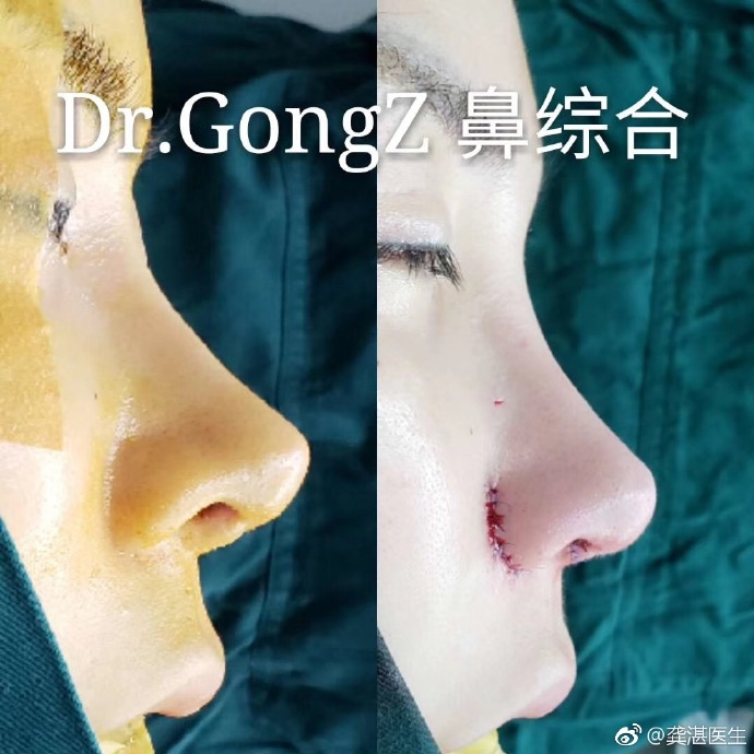 广州做鼻子&网红鼻&鼻修复知名专家推荐：龚湛（案例效果预约）怎么样？