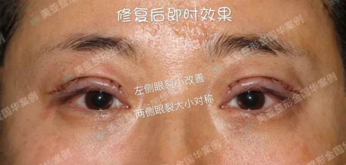 中国最好的眼修复知名专家推荐：金国华（案例预约价格）双眼皮修复怎么样？