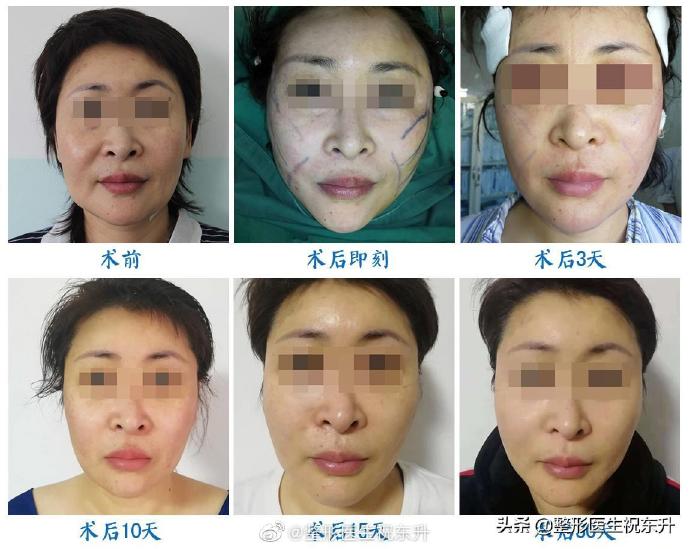 中国最好的面部提升专家：祝东升（案例预约）五层面部提升怎么样？