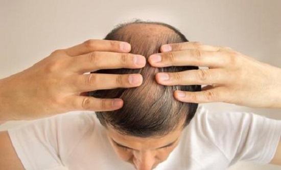 头发稀疏的三个阶段，治疗方法都是什么？