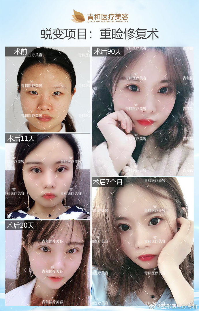 中国做双眼皮知名专家推荐：彭青和割双眼皮好看吗？技术靠谱吗？