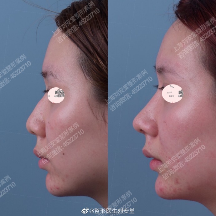 全国鼻综合知名专家推荐：刘安堂（案例预约效果）鼻综合做的好吗，大概多少钱？