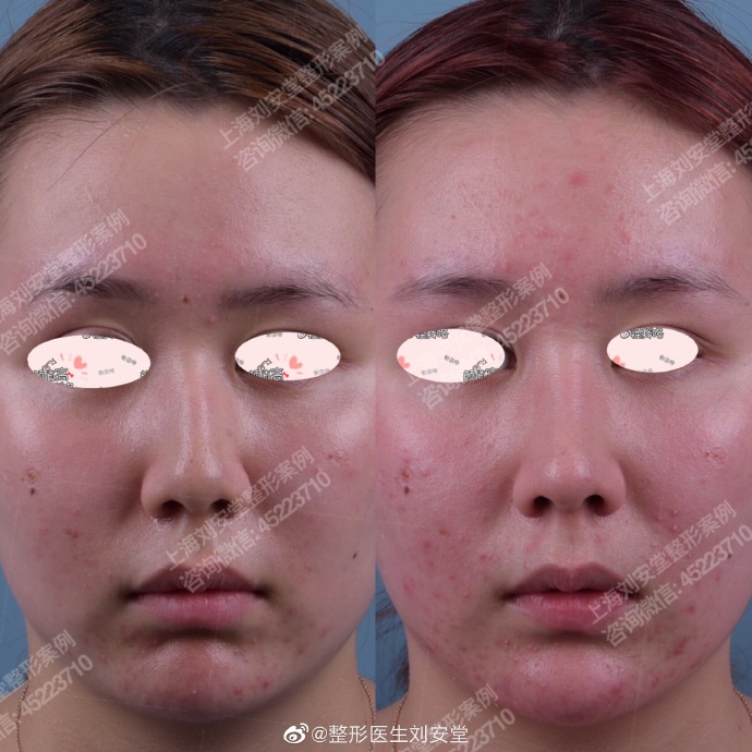 全国鼻综合知名专家推荐：刘安堂（案例预约效果）鼻综合做的好吗，大概多少钱？