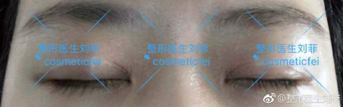 上海九院割双眼皮最好的专家推荐：刘菲（案例预约价格效果）怎么样？
