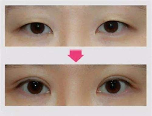 杭州做双眼皮知名专家推荐：杭州薛旦做双眼皮技术怎么样？大概费用多少？