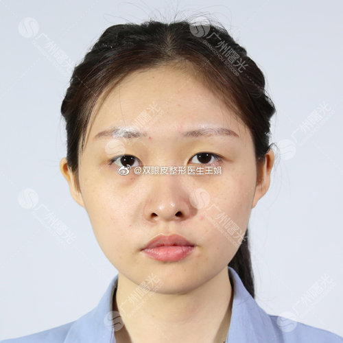 广州做眼部整形眼综合开眼角专家推荐：广州曙光王娟双眼皮做的自然吗？
