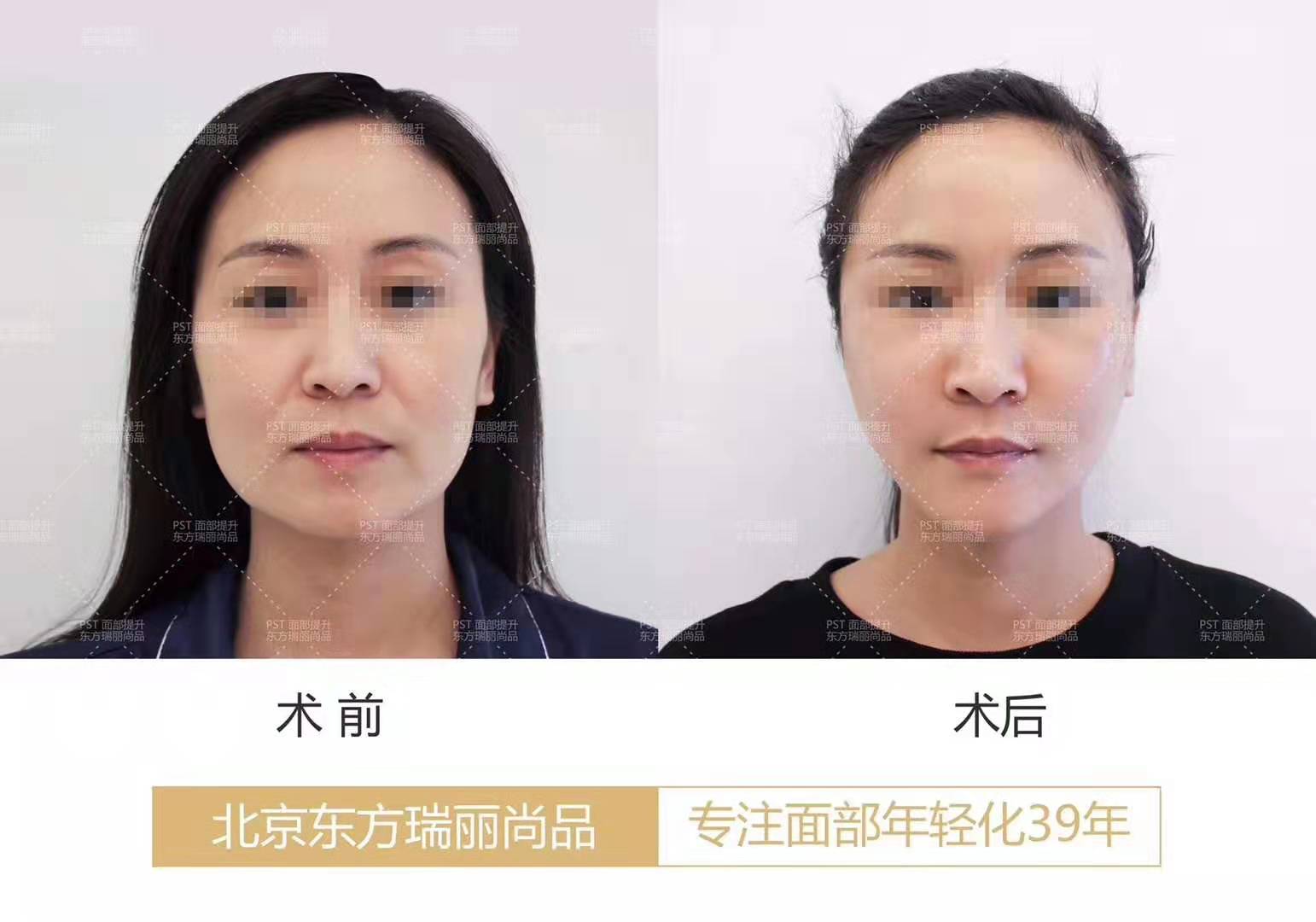 北京李晓东和杨大平谁做面部提升（案例价格预约）哪个技术好？