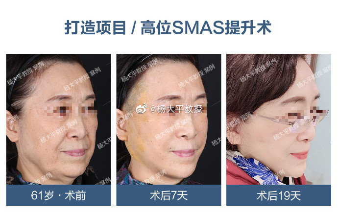 北京李晓东和杨大平谁做面部提升（案例价格预约）哪个技术好？