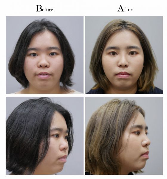 女士三段式隆鼻、鼻头塑型、敲鼻骨真实案例前后对比图