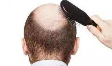 毛发移植术后可以带帽子吗?移植后多久可以清洗头发?毛发移植常见问题