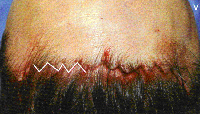 发际线前额拉皮手术的效果和优缺点有哪些？