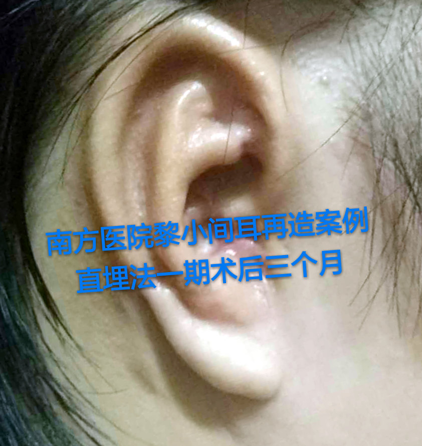 全国耳再造耳畸形最好的专家：广州南方医院黎小间医生耳再造技术到底好不好？