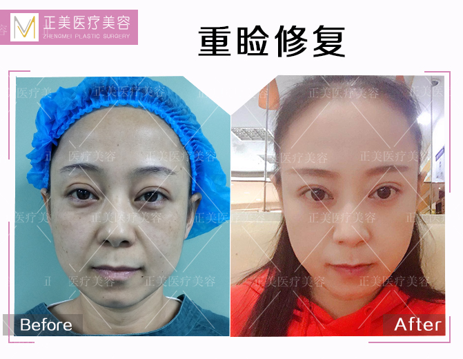 中国最好的双眼皮修复专家：郑永生双眼皮修复案例、价格和技术评价预约