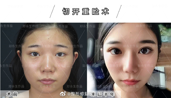 中国最好的双眼皮修复专家：郑永生双眼皮修复案例、价格和技术评价预约