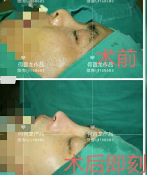 国内顶级鼻修复和自体软骨隆鼻专家：上海王会勇和何晋龙谁做的鼻子好？
